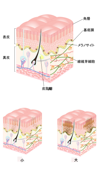 シミ・色素沈着の対処法→まずはタイプを知りましょう