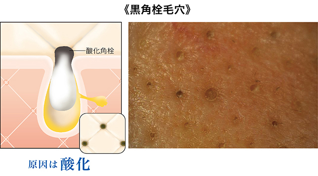 詰まっていないのに黒い もうひとつの黒ずみの正体 美的 Com