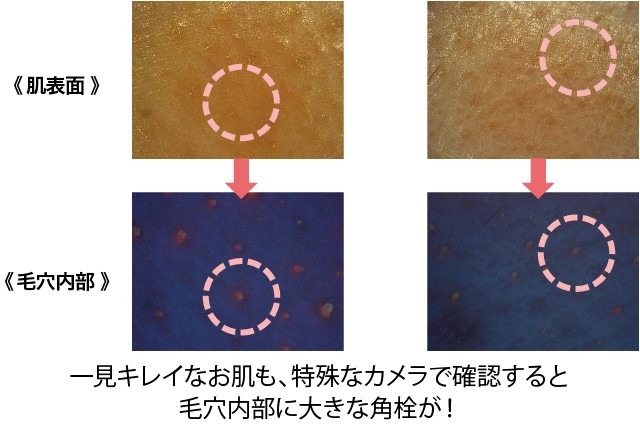 毛穴種類制作用