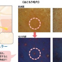 年の始めにお肌のリセット　冬の角質ケアのススメ