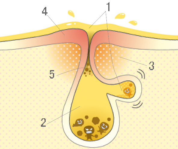 皮膚科医に聞く！繰り返す大人ニキビの原因は？