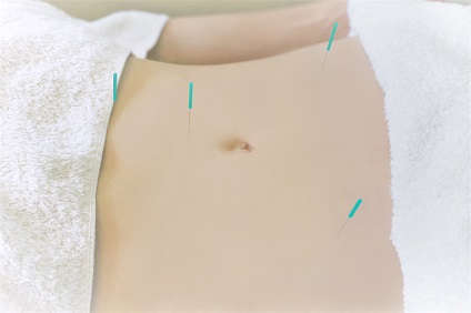 腸活の新たな注目メソッド登場!   美腸鍼と＜腸育＞サプリで、巡るからだを即実感