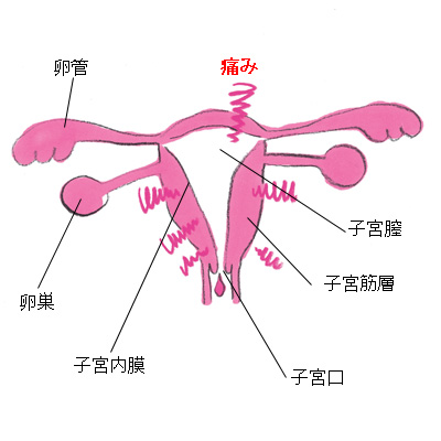 生理痛の原因って？