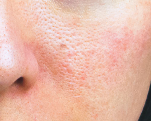 ブツブツ肌荒れの原因は 顔の毛穴トラブルの種類や肌質別ケア法を解説 美的 Com