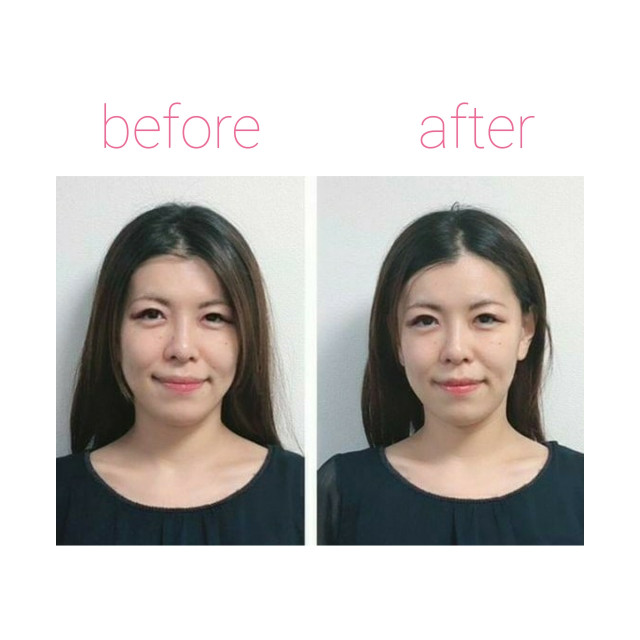 筋膜に注目した小顔矯正に行ってきました 美的クラブ通信 美的 Com 筋膜に注目した小顔矯正に行ってきました 美的クラブ通信 美的 Com