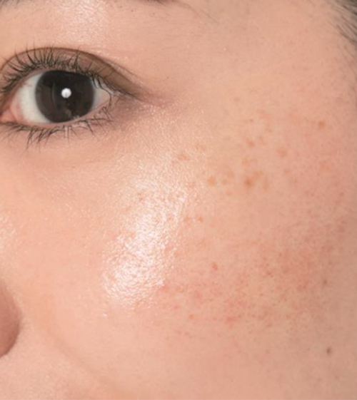 まるっと解説 そばかす シミを消す方法 スキンケア レーザー治療 食べ物など 美的 Com