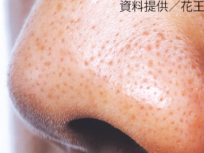 ブツブツ肌荒れの原因は 顔の毛穴トラブルの種類や肌質別ケア法を解説 美的 Com