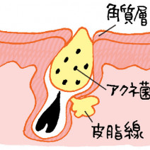 毛穴タイプ診断｜あなたの毛穴はどのタイプ？ 毛穴問題を放置すると悪のスパイラルに…