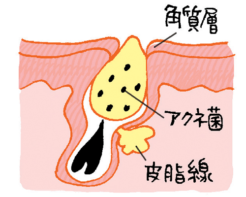 毛穴タイプ診断 あなたの毛穴はどのタイプ 毛穴問題を放置すると悪のスパイラルに 美的 Com