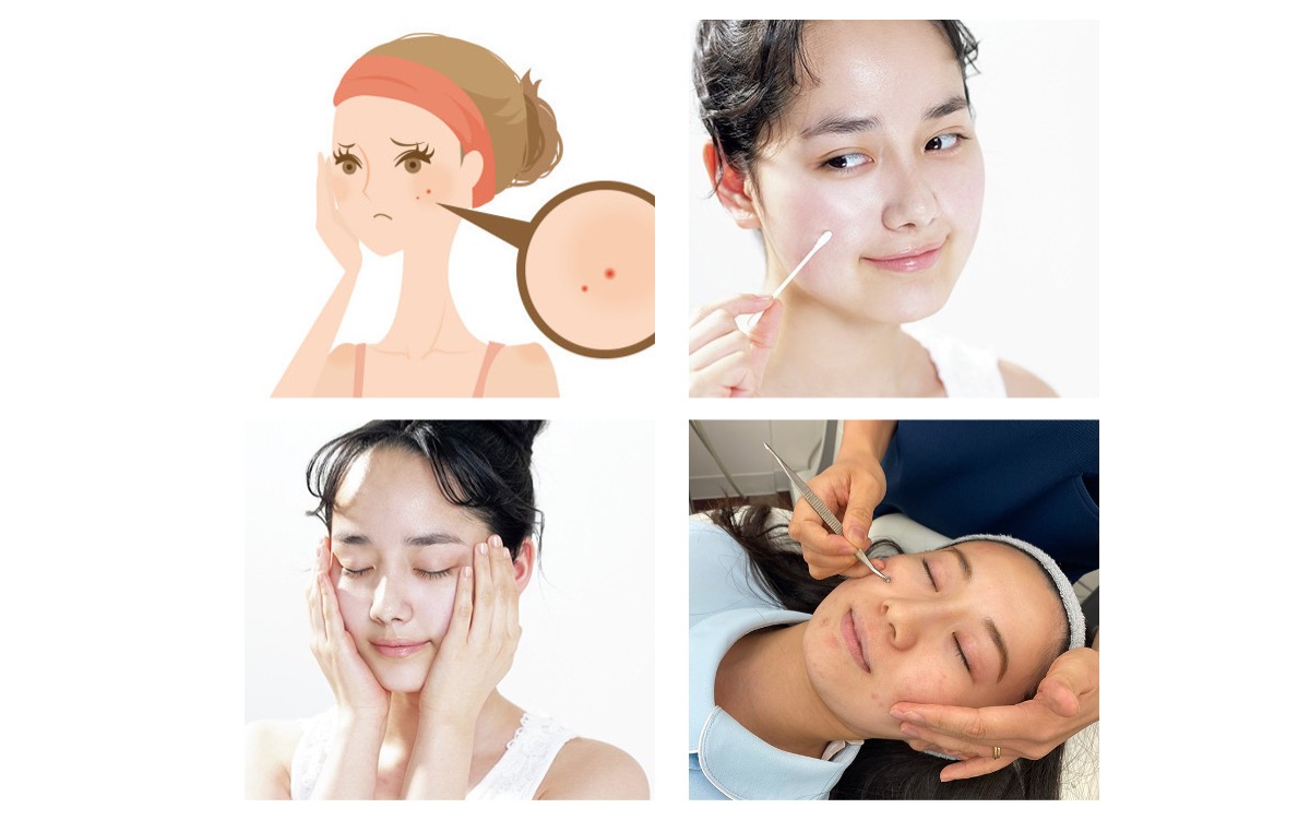 皮膚科医に聞いた なかなか 治らないニキビ の対処法を伝授 美的 Com