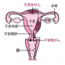20～30代が最も多い「子宮頸がん」罹患率・死亡率が増えているのは先進国で日本だけ！ その理由は？