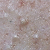 ニキビができやすいのはなぜ？大人ニキビ発生の仕組みや原因を知って対処しよう