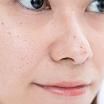 皮膚科医に聞いた デコボコ肌を改善する 原因 対策 治療法 美的 Com