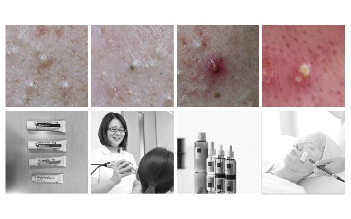 白ニキビに有効な成分は何ですか?, 白ニキビ 押し出す – LBFQ