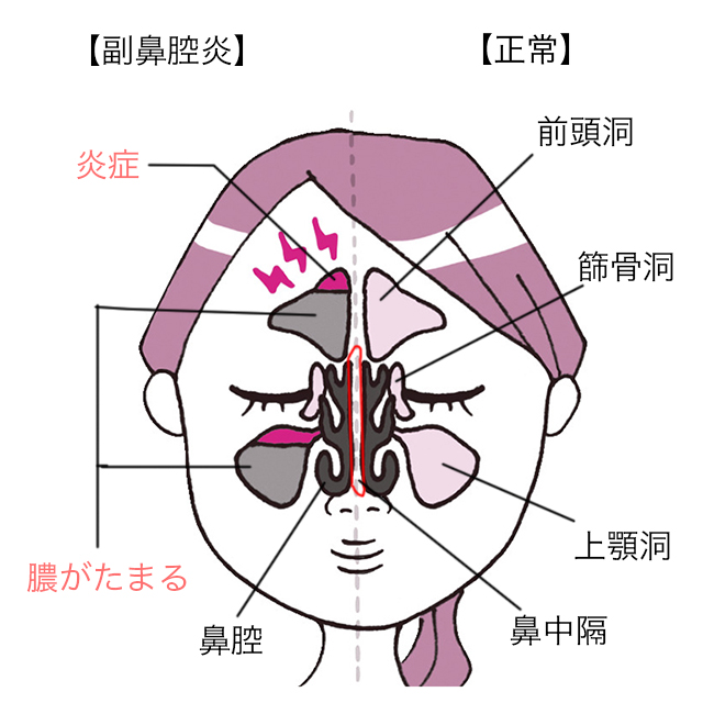 蓄膿症 膿 を 出す ツボ