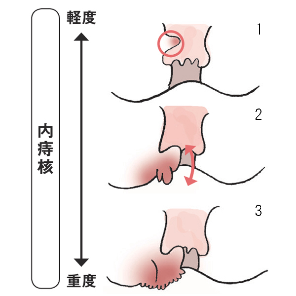 いぼ 痔 原因