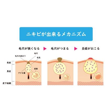 潰すのはng 黄ニキビを早く治す ６つの対処法 皮膚科医が聞く 美的 Com