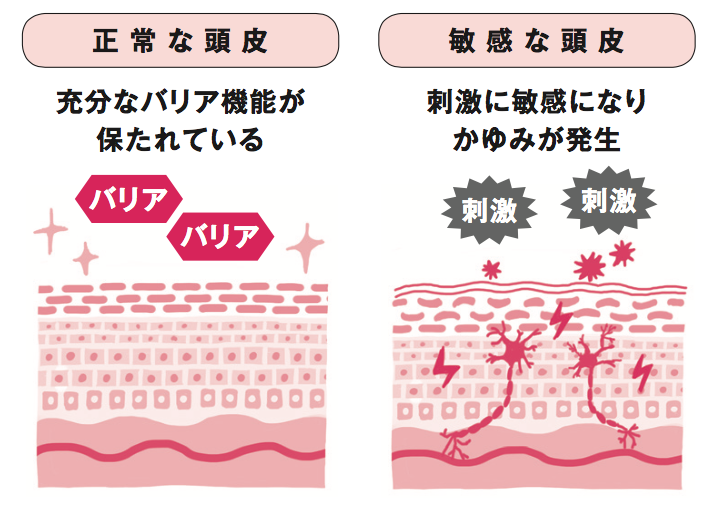 頭皮かゆみ ストレス