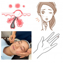 【専門家に聞く】赤ニキビの「原因」と「4つのケア法」