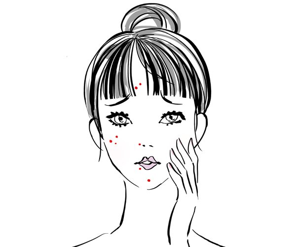 ニキビ と ストレス の関係 皮膚科医に聞くと 美的 Com ニキビ と ストレス の関係 皮膚科医に聞くと 美的 Com