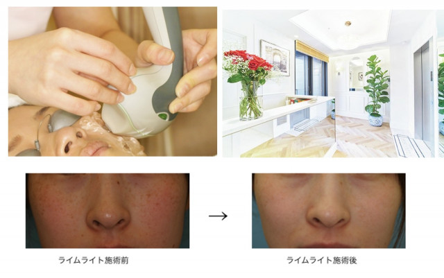 ライムライトの効果 先生に聞くと こんなシミにおすすめ 美的 Com