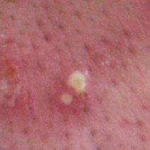 潰したらNG？「膿がたまった黄ニキビ」の原因や対処法を医師が伝授