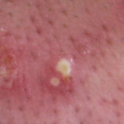 潰したらNG？「膿がたまった黄ニキビ」の原因や対処法を医師が伝授
