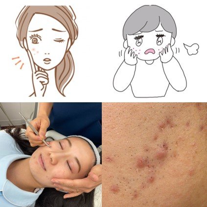 肌荒れ 赤みのあるブツブツ 正体 と 原因 と 対策 美的 Com 肌荒れ 赤みのあるブツブツ 正体 と 原因 と 対策 美的 Com
