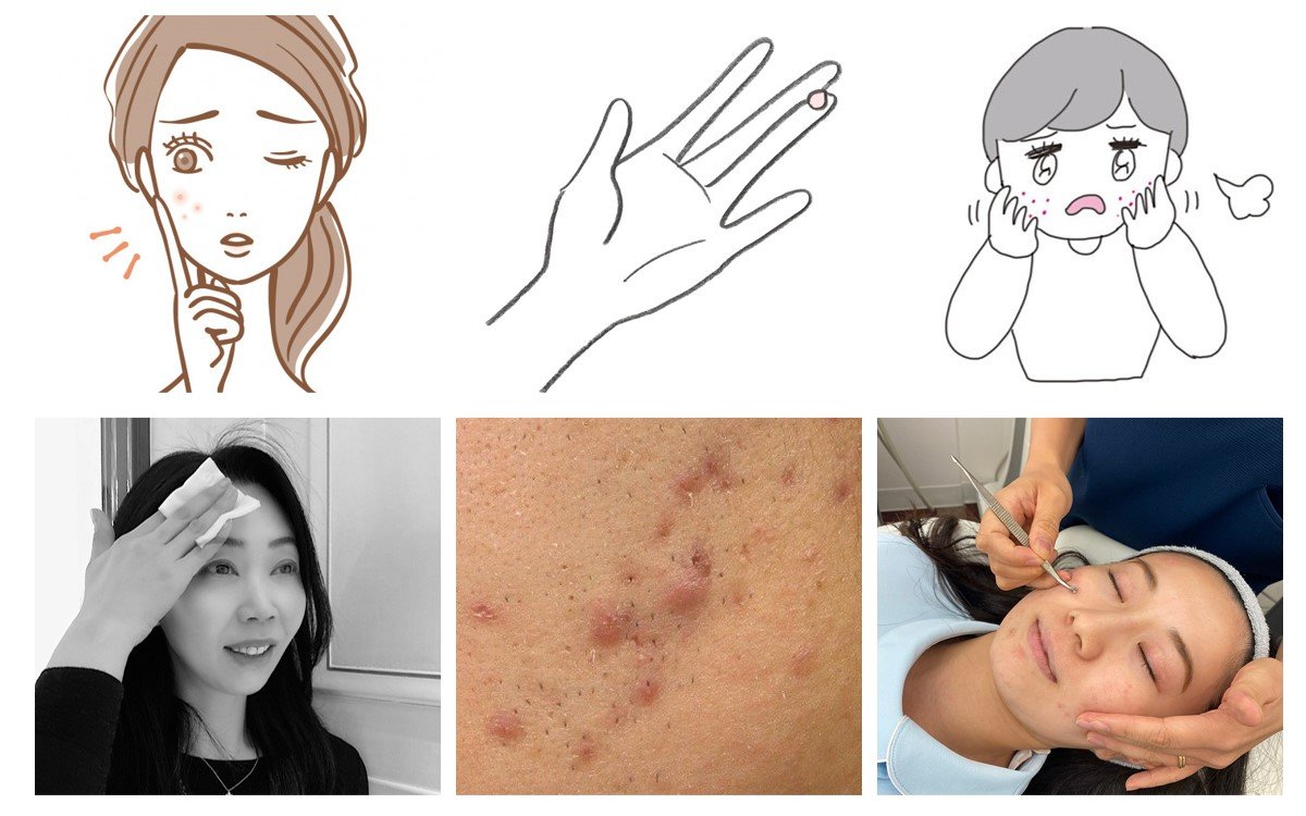 肌荒れ 赤みのあるブツブツ 正体 と 原因 と 対策 美的 Com 肌荒れ 赤みのあるブツブツ 正体 と 原因 と 対策 美的 Com