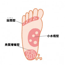 「水虫を治したい！」効果的なのは塗り薬 or 飲み薬？｜皮膚科医が詳しく解説