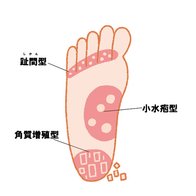 「水虫を治したい！」効果的なのは塗り薬 or 飲み薬？｜皮膚科医が詳しく解説