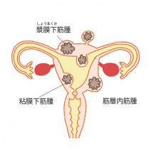 子宮筋腫ってそもそもどんな病気？ 手術したほうがいいの？｜産婦人科医が解説
