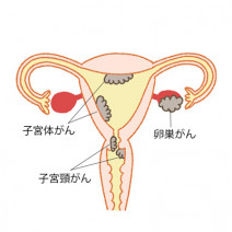 【女性のガン】「子宮がん」や「卵巣ガン」ってどんな人がなりやすいの？｜産婦人科医が解説