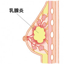 授乳中じゃなくても注意が必要！ 喫煙が原因で乳腺炎になる！？ 「乳腺症」のサインやを専門家が解説