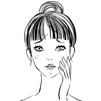 急にできた口周りのニキビ…。原因は？ 治し方は？【皮膚科医が解答】