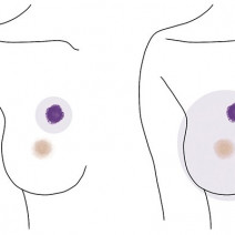 もしも乳がんになってしまったら？ 脱毛や胸を失うイメージもこれを知れば怖くない！【美的GRAND】