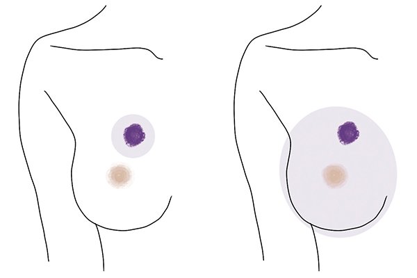 もしも乳がんになってしまったら？ 脱毛や胸を失うイメージもこれを知れば怖くない！【美的GRAND】
