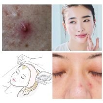 「ニキビの赤み」対処法とは？原因と自宅出来るセルフケアのやり方を紹介