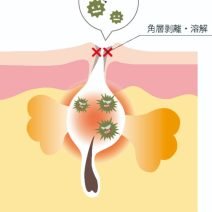【イオウ解説】角層剥離、溶解、殺菌の働きがあります