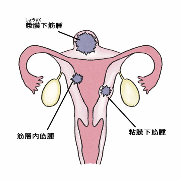 【子宮筋腫】症状や治療法は？ 定期的な婦人科検診で早期発見を！