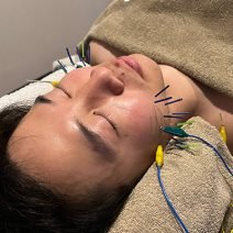 美容鍼に行ってみたら体感－10％の小顔に！？ 痛みって実際どうなの？【美容好きお笑い芸人が行く話題のビューティスポット♡vol.10】by『美的HEN』
